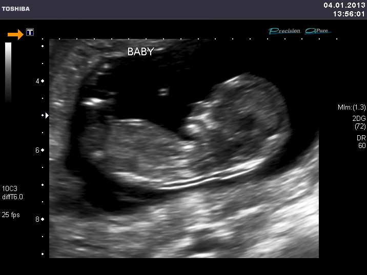 Ultrasound-edited-final.jpg